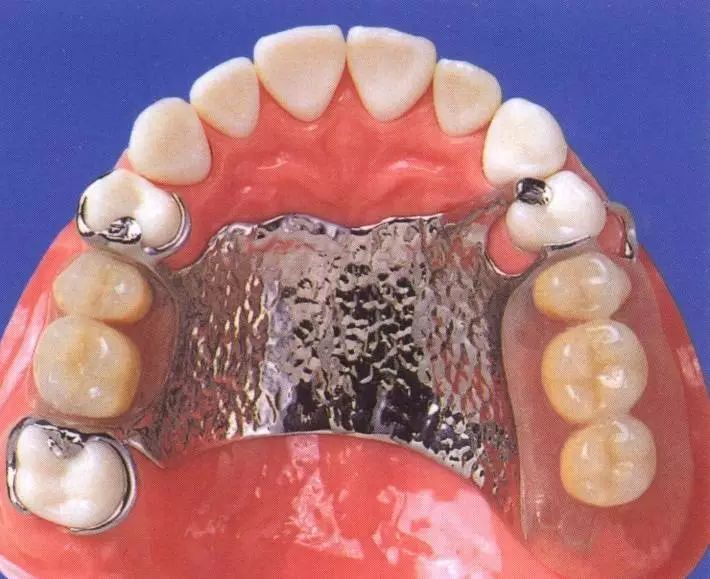 可摘局部义齿设计之四性特点  